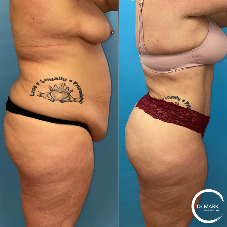 right lateral tummy tuck 1