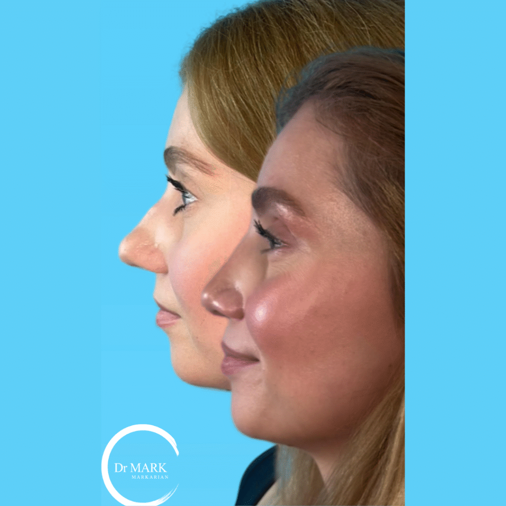 Rhinoplasty