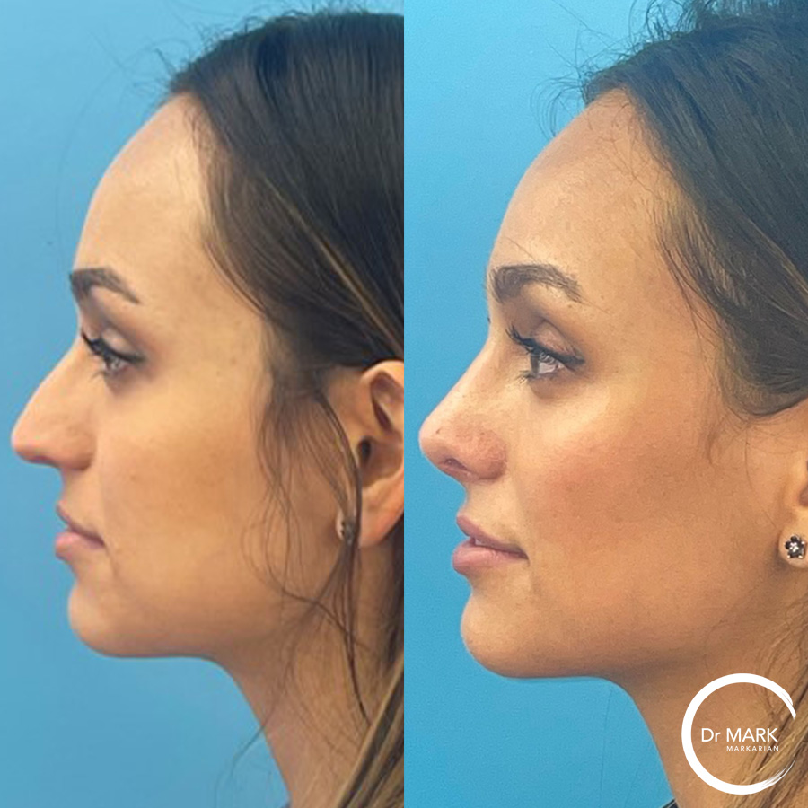 ed for rs left lateral view (1)